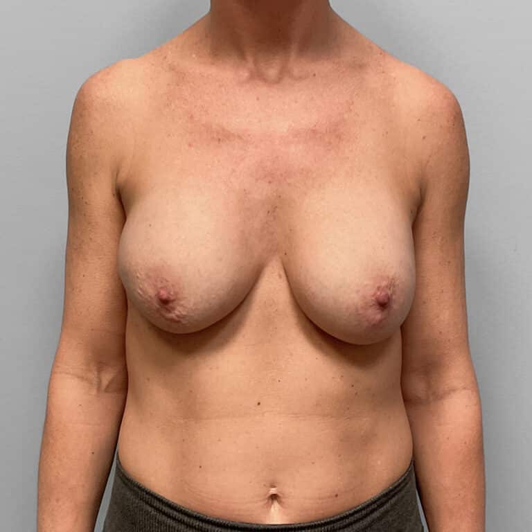 Before Image: Breast Implant Removal- Dr. Tucker - front