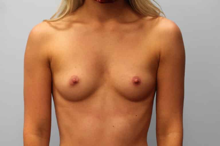 Before Image: Breast Augmentation- Dr. Howell - front