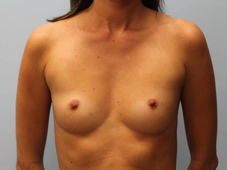 Before Image: Breast Augmentation – Dr. Tucker - front