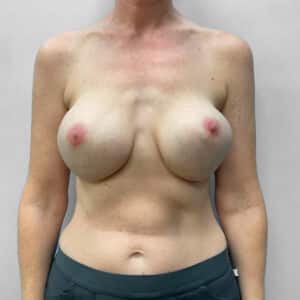 Before Image: Breast Implant Exchange – Dr. Tucker