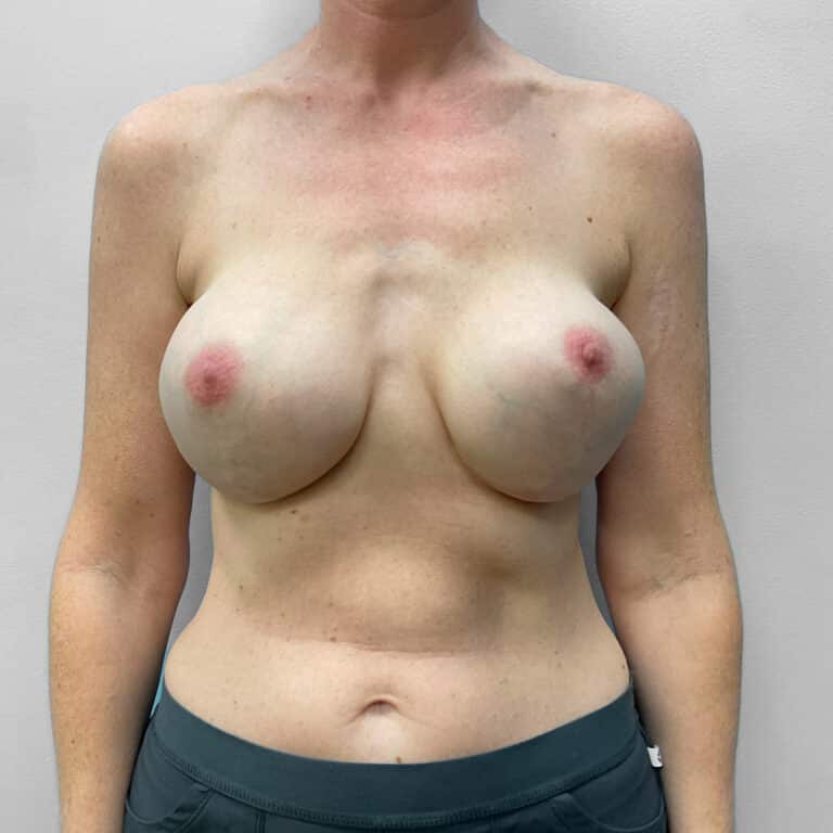Before Image: Breast Implant Exchange – Dr. Tucker - front