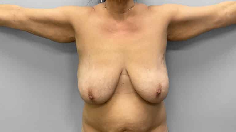 Before Image: Mommy Makeover – Dr. Tucker -