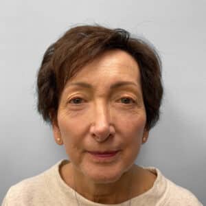 Before Image: Blepharoplasty – Dr. Tucker