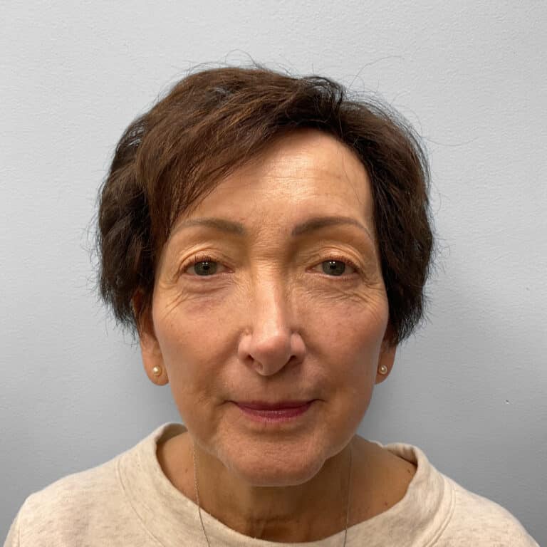 Before Image: Blepharoplasty – Dr. Tucker - front