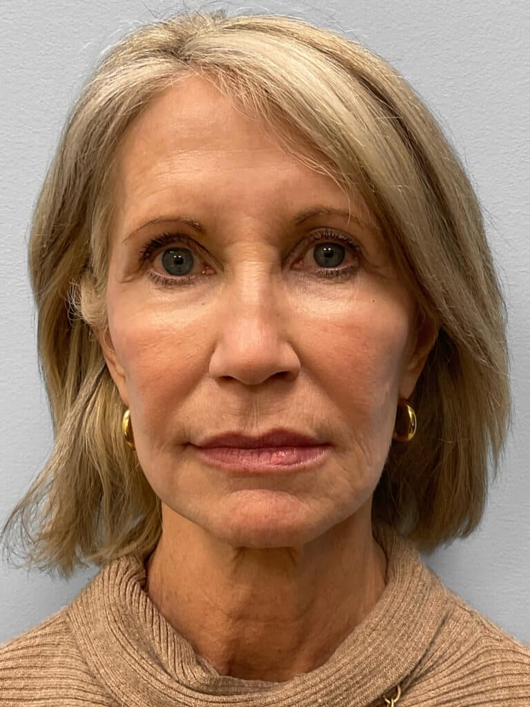 Before Image: Browlift & Laser Resurfacing – Dr. Tucker - front