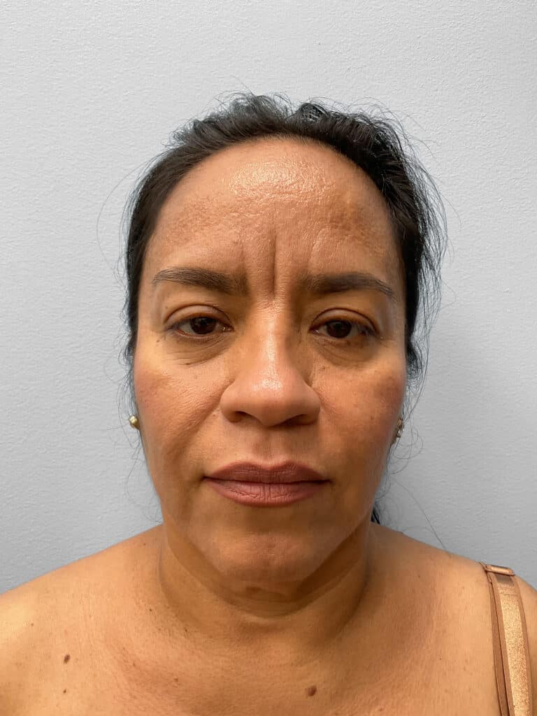 Before Image: Face & Browlift – Dr. Tucker - front