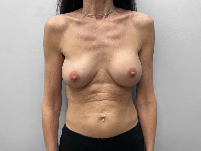 Before Image: Breast Implant Exchange – Dr. Tucker - front