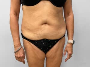 Before Image: Tummy Tuck – Dr. Tucker