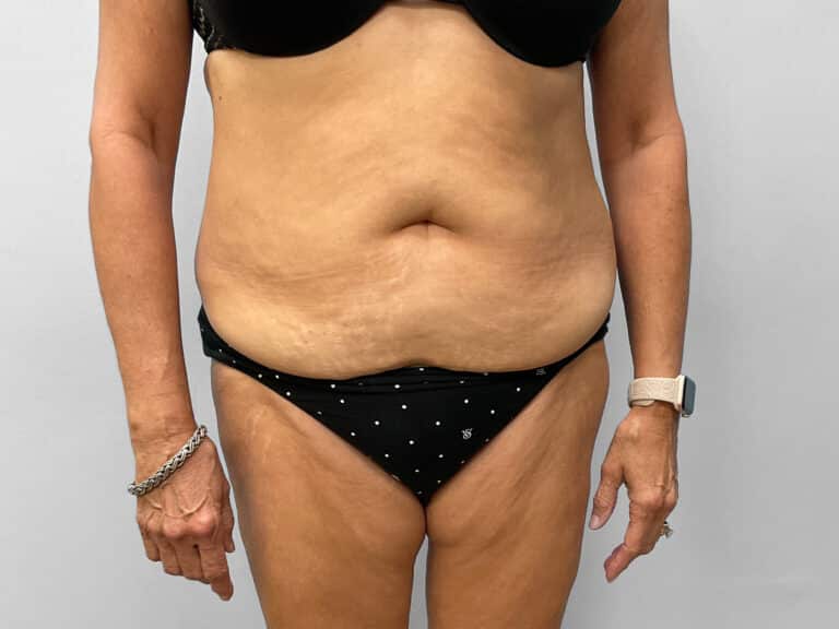 Before Image: Tummy Tuck – Dr. Tucker - front