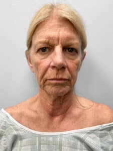 Before Image: Facelift, Blepharoplasty, & TFX – Dr. Tucker
