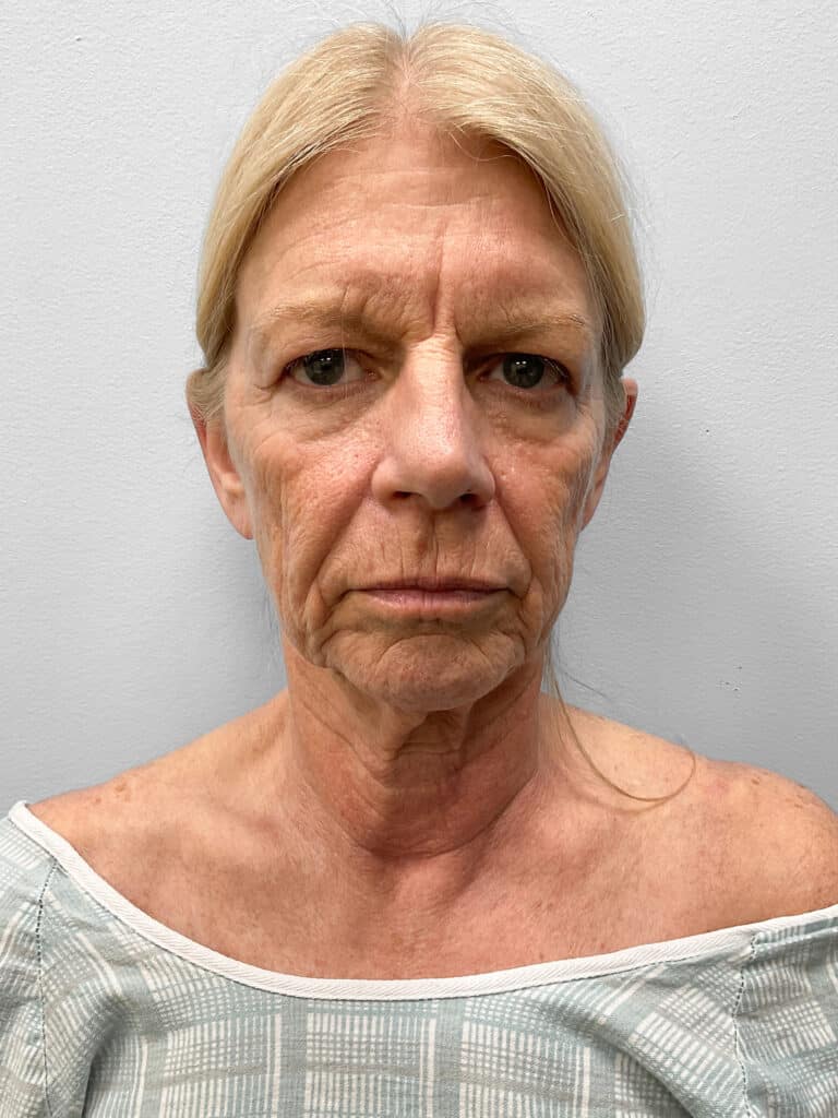 Before Image: Facelift, Blepharoplasty, & TFX – Dr. Tucker - front