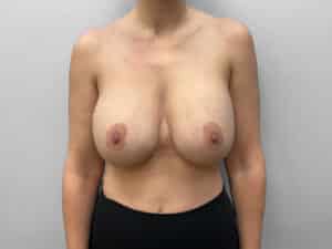 Before Image: Breast Augmentation & Lift – Dr. Tucker