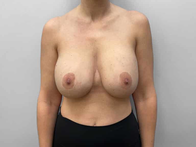 Before Image: Breast Augmentation & Lift – Dr. Tucker - front