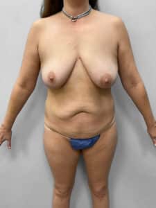 Before Image: Mommy Makeover – Dr. Tucker