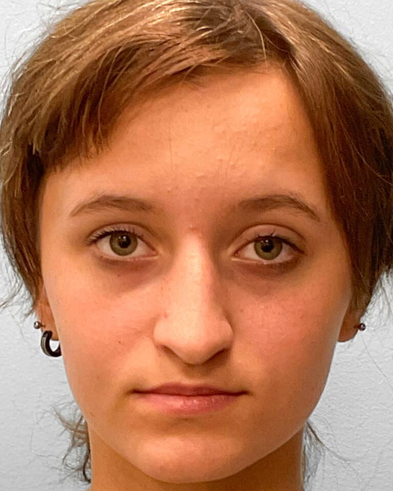 Before Image: Rhinoplasty – Dr. Tucker - front
