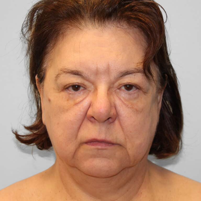 Before Image: Facelift & Blepharoplasty – Dr. Tucker - front
