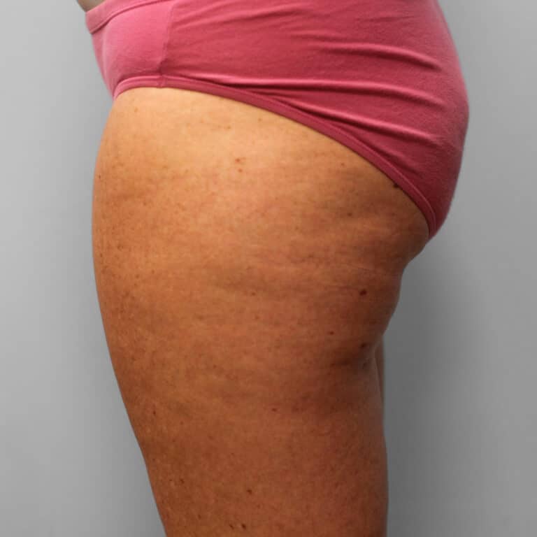 Before Image: Mommy Makeover – Dr. Tucker - other