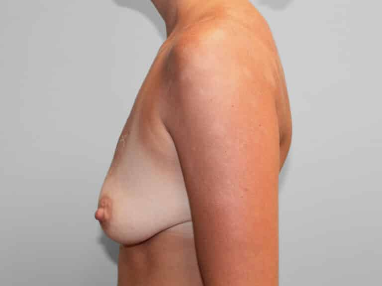 Before Image: Breast Augmentation -Dr. Tucker - left-side