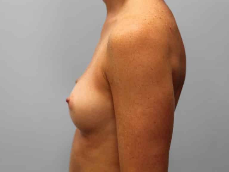 Before Image: Breast Augmentation- Dr. Tucker - left-side