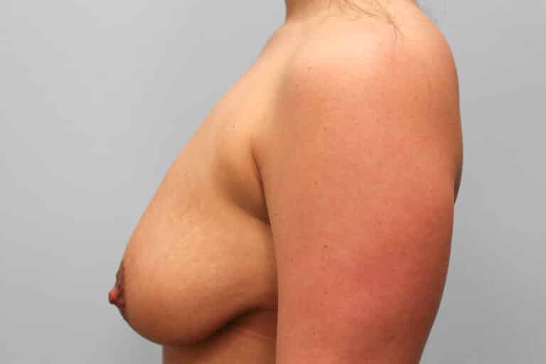 Before Image: Breast Augmentation – Dr. Tucker - left-side