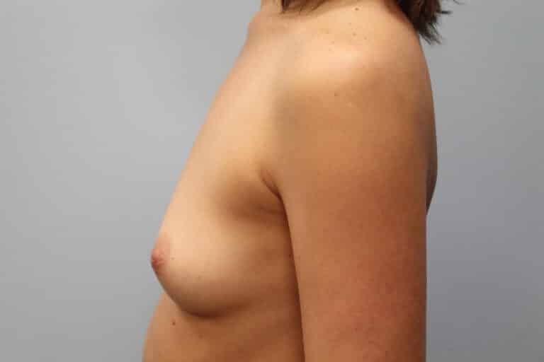 Before Image: Breast Augmentation – Dr. Tucker - left-side