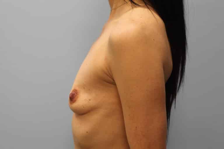 Before Image: Breast Augmentation-Dr. Howell - left-side