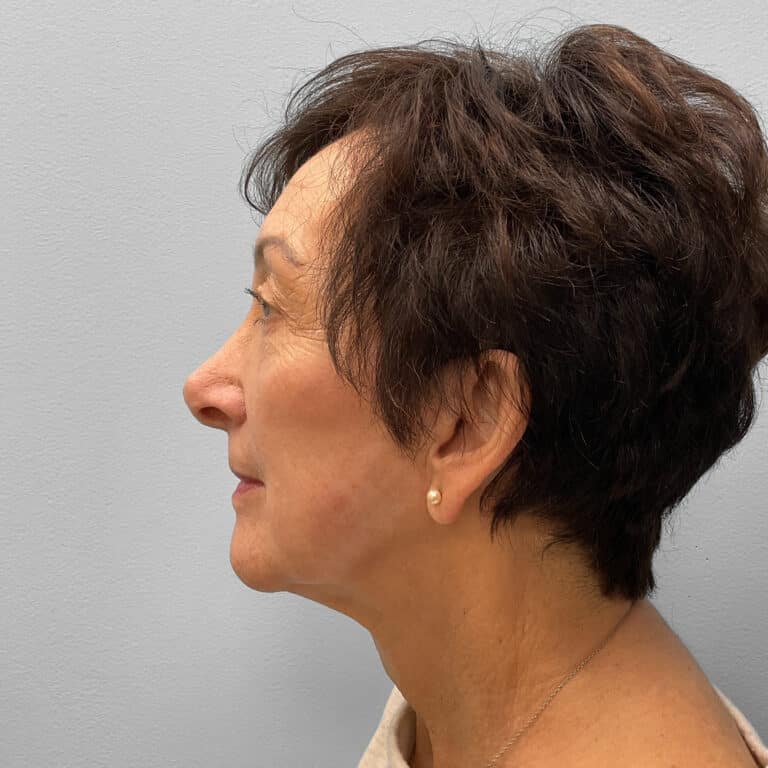 Before Image: Blepharoplasty – Dr. Tucker - left-side