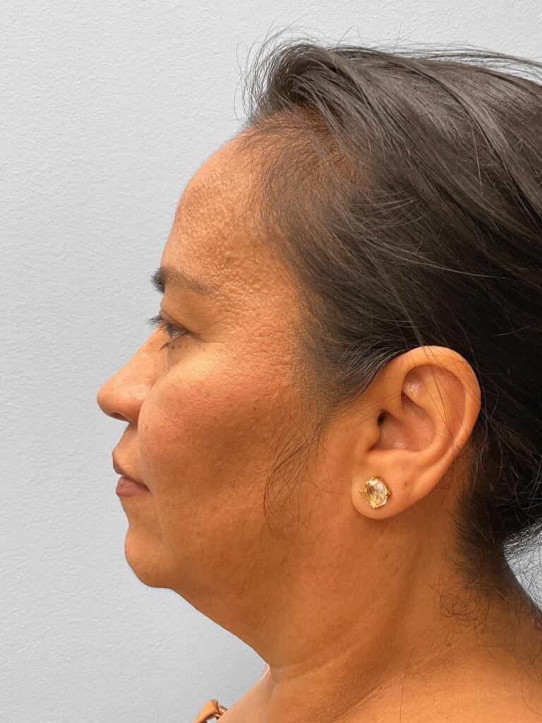 Before Image: Face & Browlift – Dr. Tucker - left-side