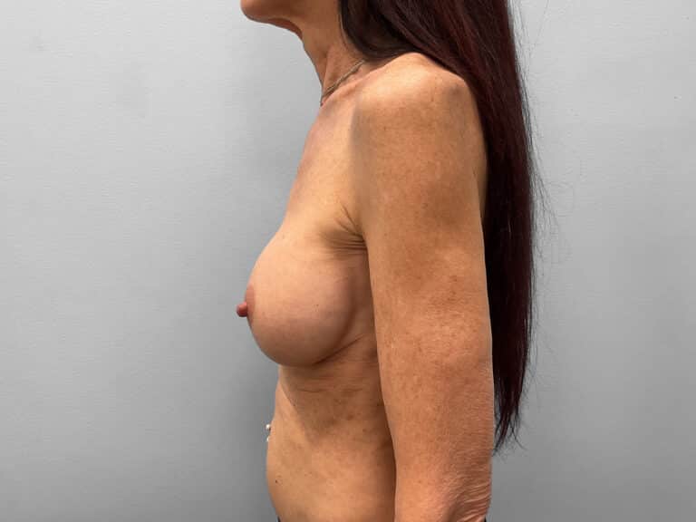 Before Image: Breast Implant Exchange – Dr. Tucker - left-side