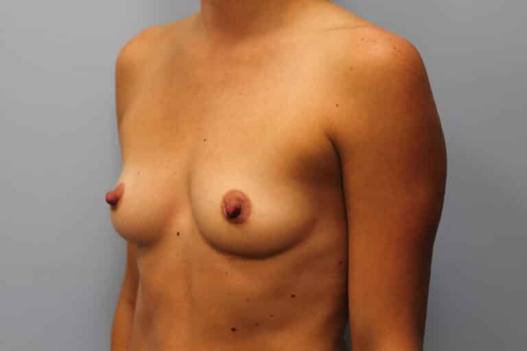 Before Image: Breast Augmentation – Dr. Howell - left-front-oblique