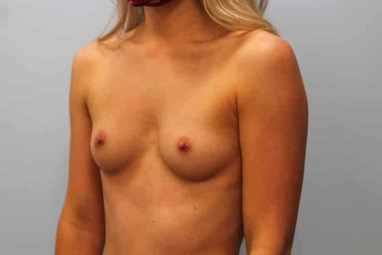 Before Image: Breast Augmentation- Dr. Howell - left-front-oblique