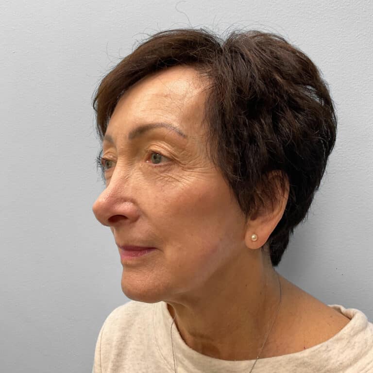 Before Image: Blepharoplasty – Dr. Tucker - left-front-oblique