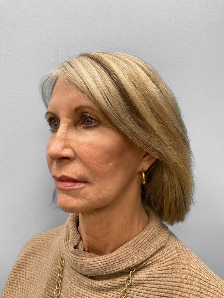 Before Image: Browlift & Laser Resurfacing – Dr. Tucker - left-front-oblique