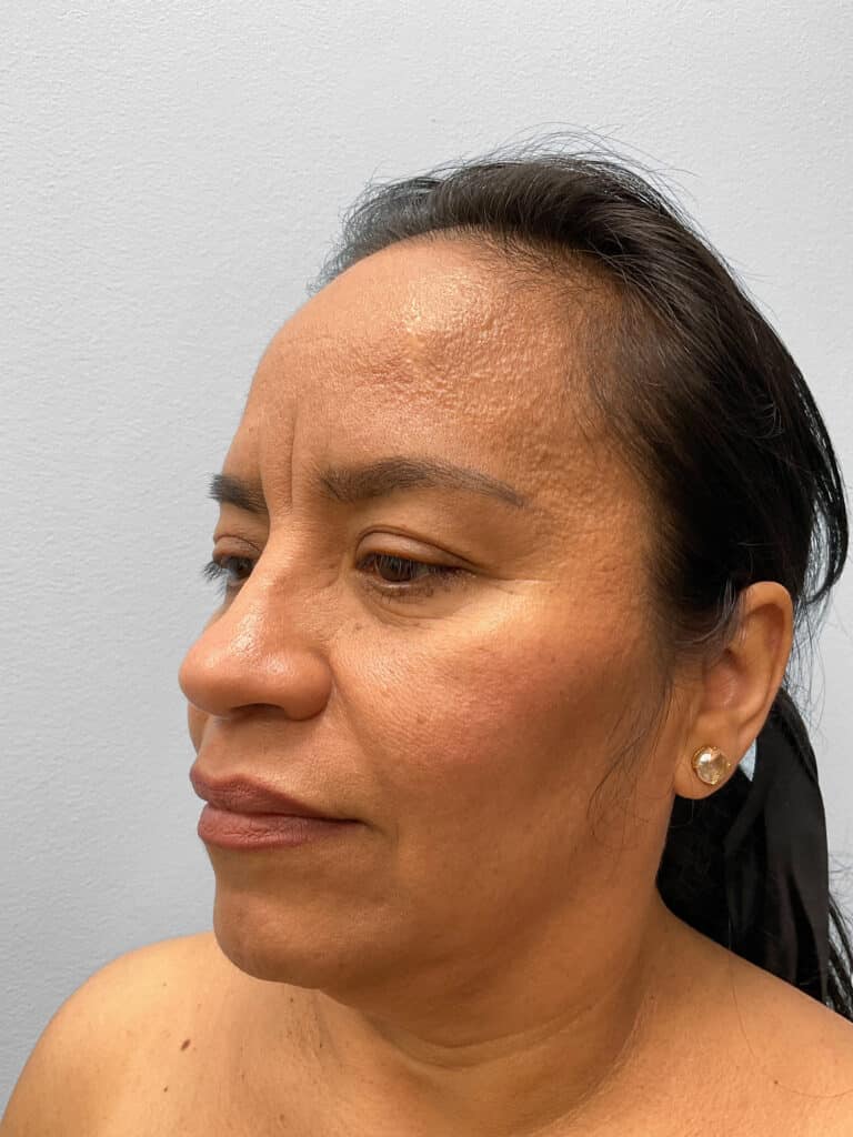 Before Image: Face & Browlift – Dr. Tucker - left-front-oblique