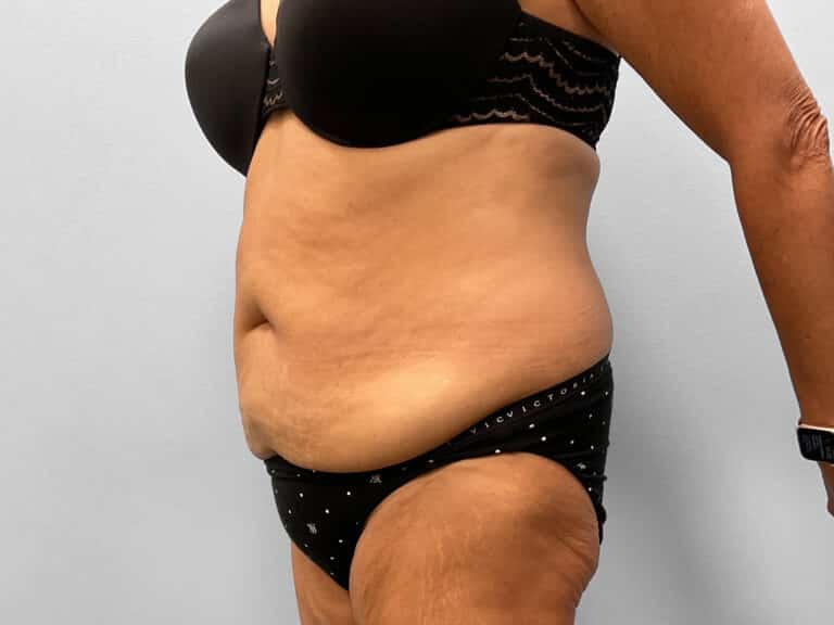 Before Image: Tummy Tuck – Dr. Tucker - left-front-oblique