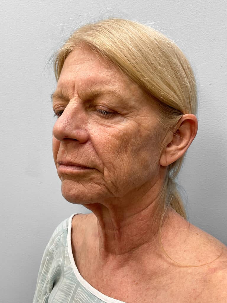 Before Image: Facelift, Blepharoplasty, & TFX – Dr. Tucker - left-front-oblique