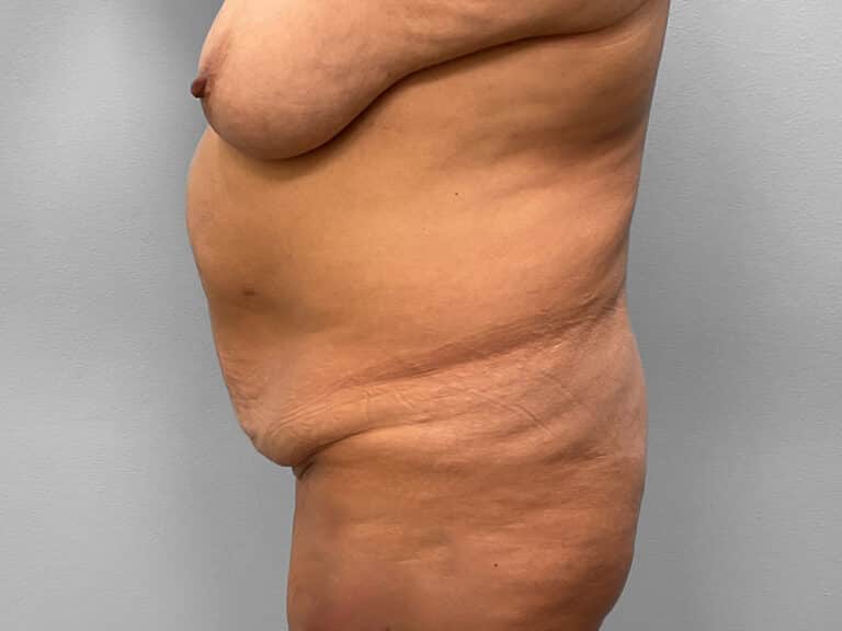 Before Image: Mommy Makeover – Dr. Tucker -