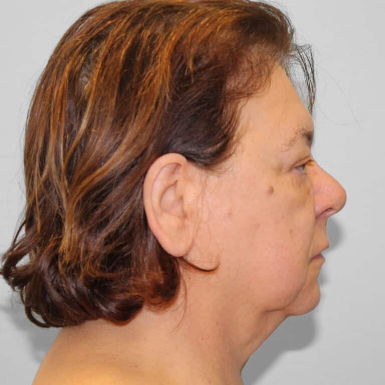 Before Image: Facelift & Blepharoplasty – Dr. Tucker - right-side