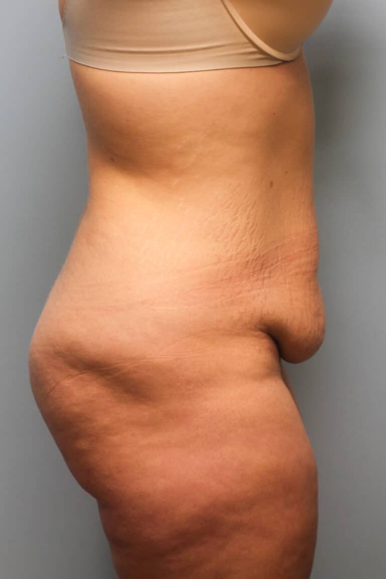 Before Image: Abdominoplasty – Dr. Howell - right-side