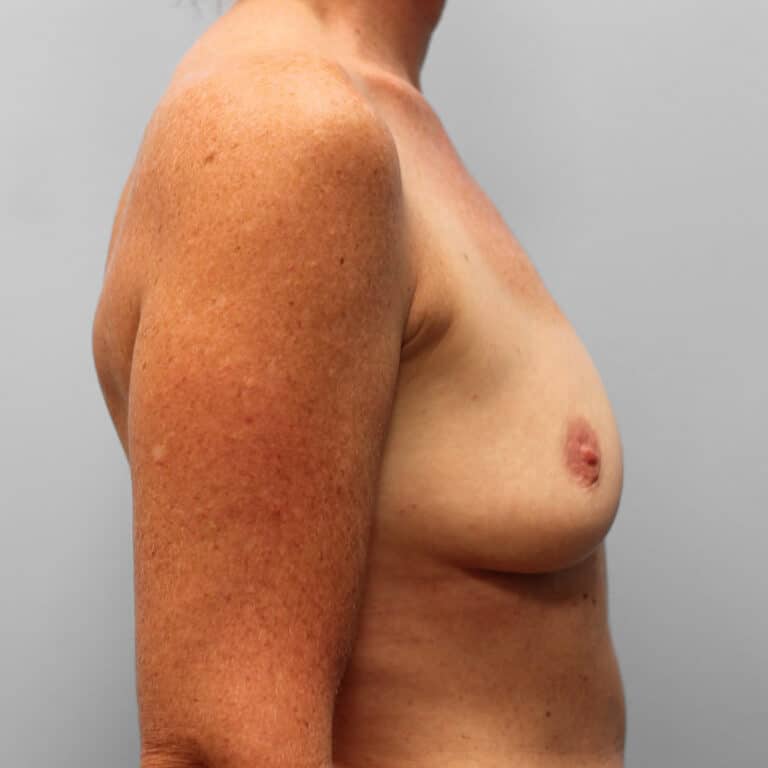 Before Image: Mommy Makeover – Dr. Tucker - right-side