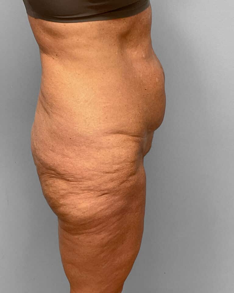 Before Image: Abdominoplasty & Thigh Lift – Dr. Tucker - right-side