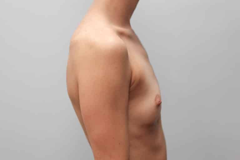 Before Image: Breast Augmentation – Dr. Tucker - right-side