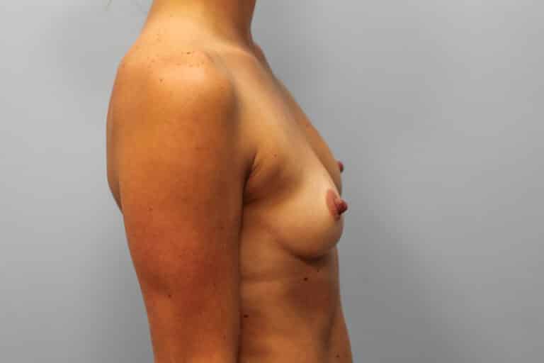 Before Image: Breast Augmentation – Dr. Howell - right-front-oblique