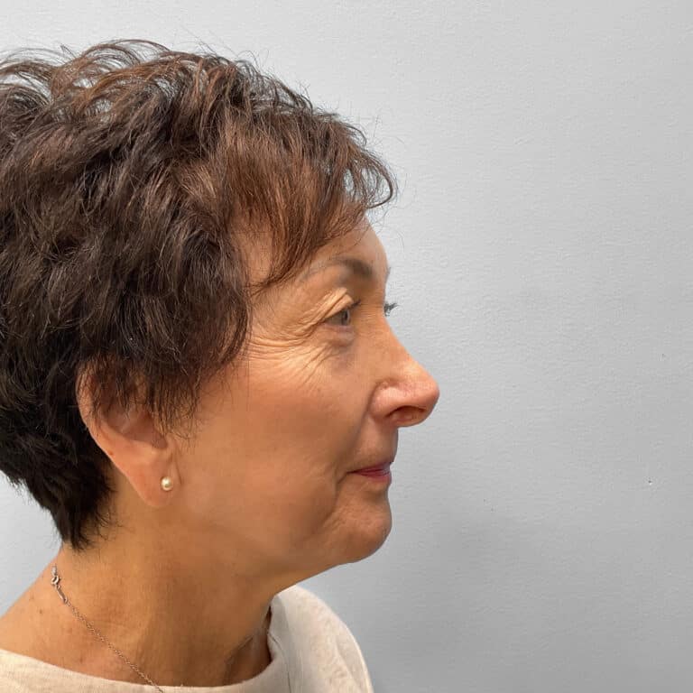 Before Image: Blepharoplasty – Dr. Tucker - right-side