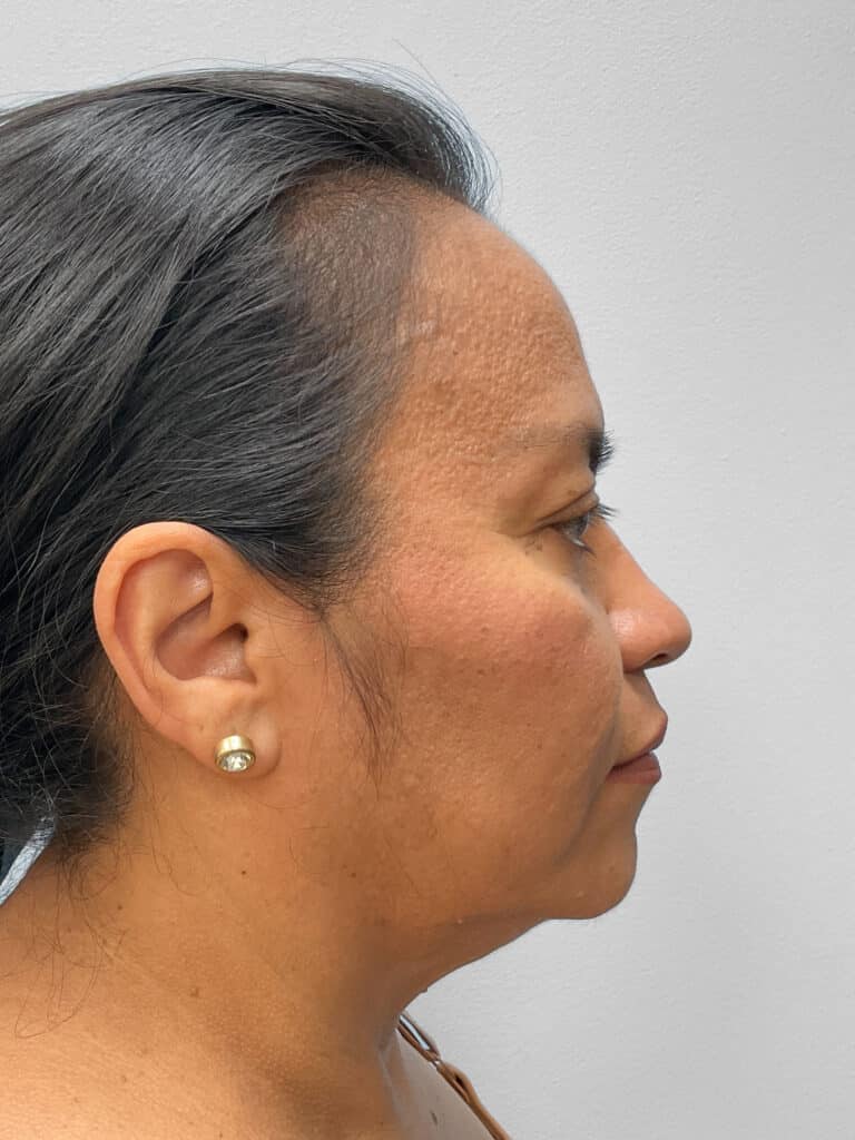 Before Image: Face & Browlift – Dr. Tucker - right-side