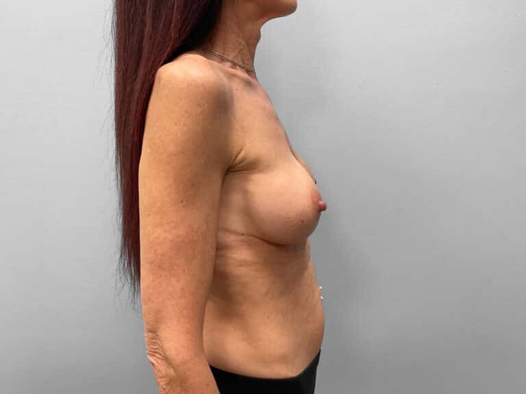 Before Image: Breast Implant Exchange – Dr. Tucker - right-side