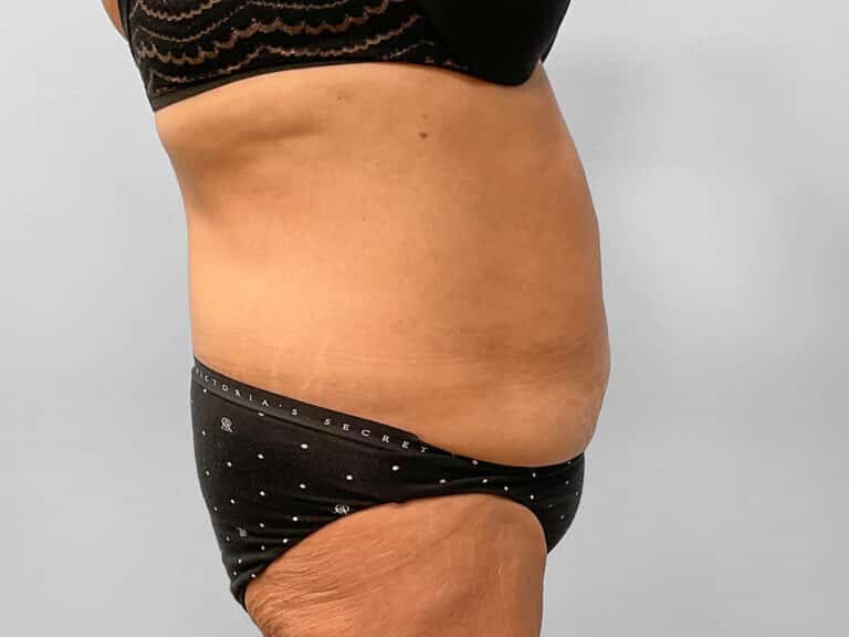 Before Image: Tummy Tuck – Dr. Tucker - right-side