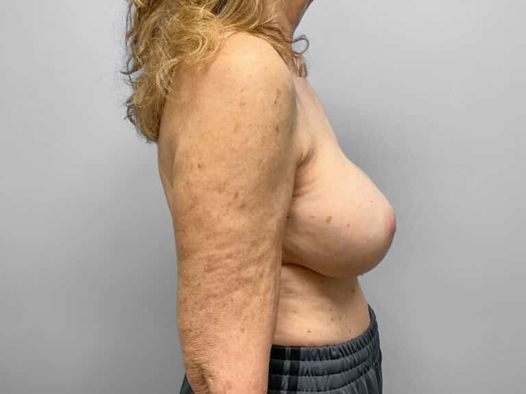 Before Image: Breast Augmentation – Dr. Tucker - right-side