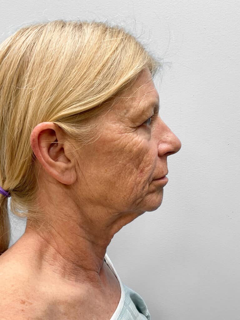 Before Image: Facelift, Blepharoplasty, & TFX – Dr. Tucker - right-side