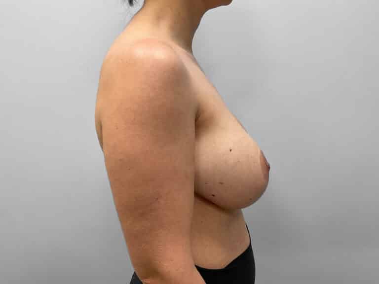 Before Image: Breast Augmentation & Lift – Dr. Tucker - right-side